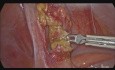 Appendicectomie par cœlioscopie en raison de l'appendicite aiguë secondaire à une infestation par un ver intestinal
