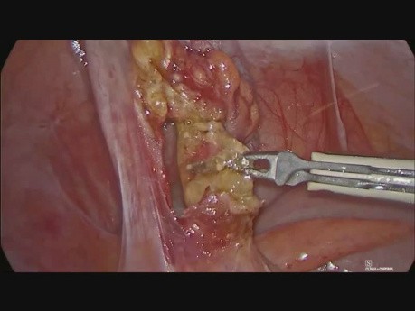 Appendicectomie par cœlioscopie en raison de l'appendicite aiguë secondaire à une infestation par un ver intestinal