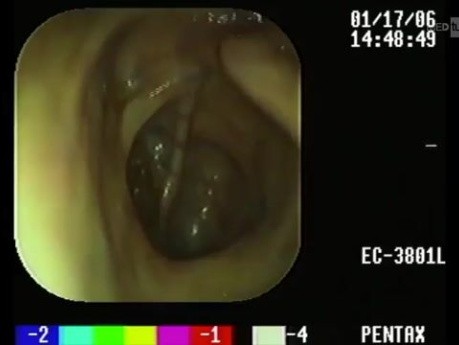 Pneumatose Intestinale Kystique - Coloscopie