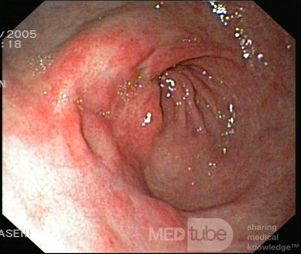 La gastrite érosive - vue endoscopique.