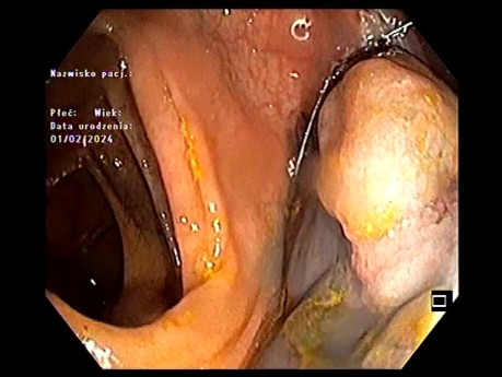 Résection Endoscopique LST Pré-incisée Latérale