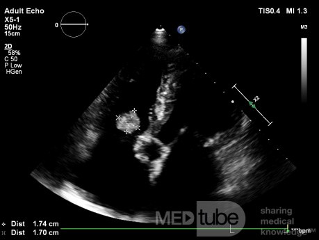 Endocardite infectieuse de la valve tricuspide.