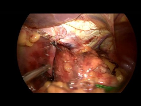 Fundoplicature de Toupet avec Placement d'une Prothèse pour une Grande Hernie Hiatale