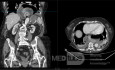 Incarcerated Thoracic Stomach
