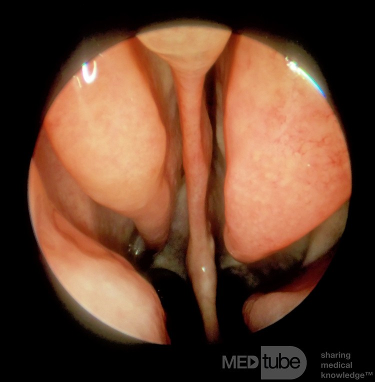 Perforation septale nasale sous-totale