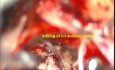 Neurinome de l'Acoustique -Excision Microchirurgicale- Préservation du Nerf Facial