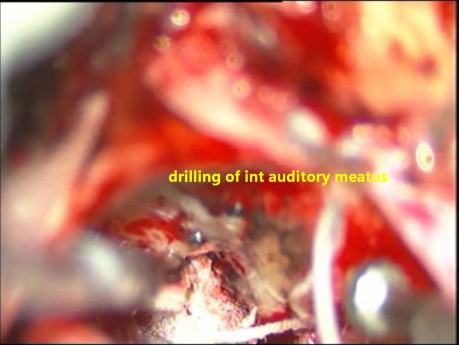 Neurinome de l'Acoustique -Excision Microchirurgicale- Préservation du Nerf Facial