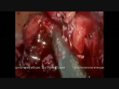 Appendicectomie Laparoscopique pour Appendicite Gangréneuse