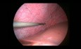 Endométriose du diaphragme - intervention laparoscopique