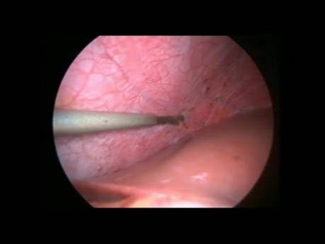 Endométriose du diaphragme - intervention laparoscopique