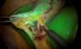Cholocystectomie laparoscopique utilisant la cholangiographie fluorescente ICG peropératoire