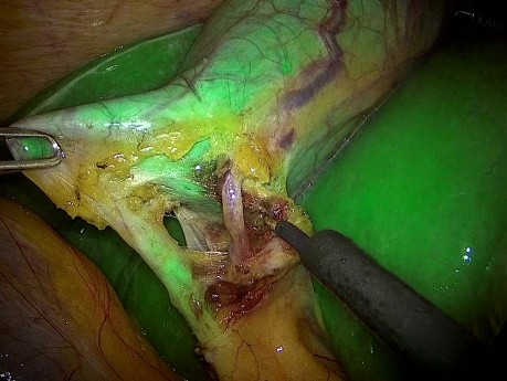 Cholocystectomie laparoscopique utilisant la cholangiographie fluorescente ICG peropératoire