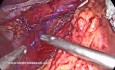 Allongement de l'Oesophage lors de la Cure de Hernie Hiatale – Technique de Libération du Nerf Vague 