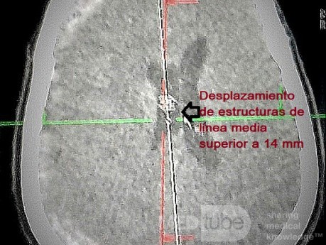 Hémorragie Sous-Durale Spontanée Aiguë dans l'espace sous-dural