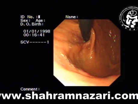 Diverticule oesophagien