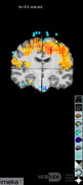 Planification Chirurgicale avec Neuronavigation chez un Patient présentant une Masse Intracrânienne. Gliome de haut grade.