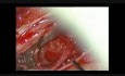 Méningiome Rachidien – Ablation Microchirurgicale