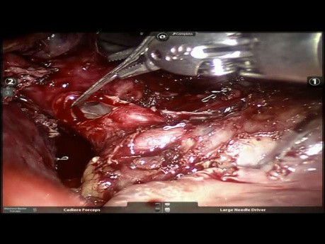 Tumeur carcinoïde du lobe inférieur droit