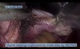 Ovariectomie salpingo vaginale simplifiée par vNOTES chirurgie des orifices naturels