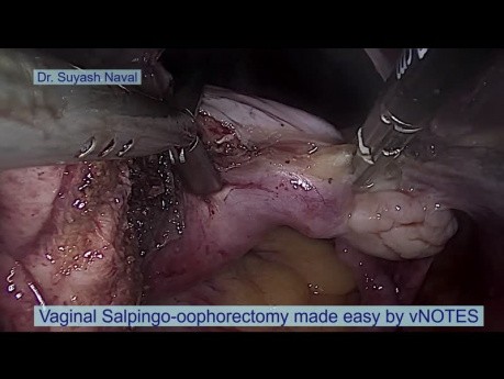 Ovariectomie salpingo vaginale simplifiée par vNOTES chirurgie des orifices naturels