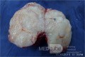 Fibroadénome mammaire géant 