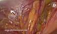 Deux coupables dans le Même Plan : Lipome du Cordon et Hernie Indirecte