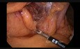 Colectomie transverse par voie laparoscopique pour cancer du côlon