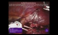 Néphrectomie Partielle Robotisée Utilisant des Sutures à Barbes Quill