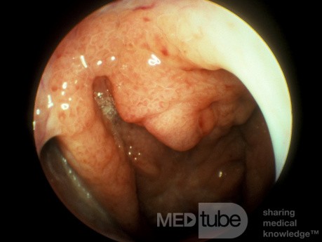 Carcinome du nasopharynx