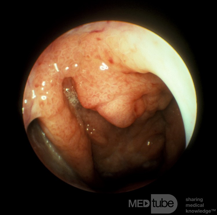 Carcinome du nasopharynx