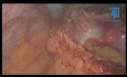 Tumeur Stromale Colon Transverse; Colectomie par Monotrocart de Type SILS