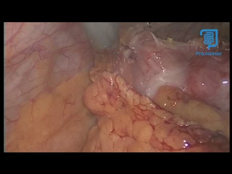 Tumeur Stromale Colon Transverse; Colectomie par Monotrocart de Type SILS