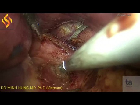 Fundoplicature de Nissen dans le traitement du RGO