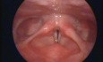 Nodules sur les cordes vocales