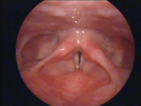 Nodules sur les cordes vocales