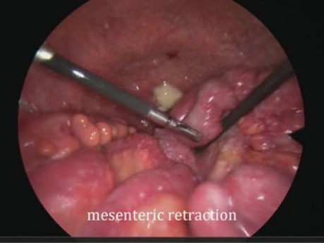 Laparoscopie pour le diagnostic de malignité intrapéritonéale, application du score de Fagotti