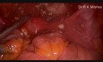 Exérèse d'un kyste dermoïde par voie laparoscopique