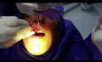 Chirurgie de la longueur de la couronne