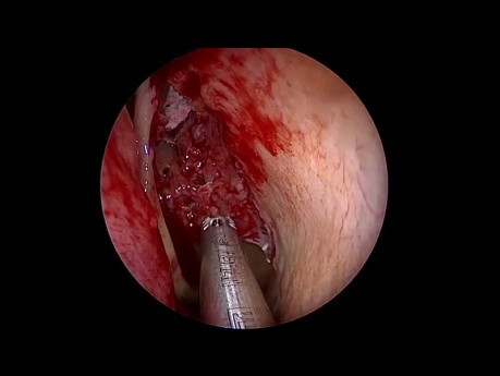 Chirurgie des Sinus Endoscopique Complète  - Approche Systématique Avant-Arrière