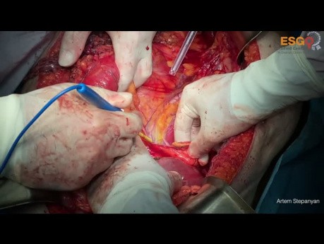 Chirurgie cytoréductive du cancer de l'ovaire. Résection en un bloc du cancer de l'ovaire de stade IIIC.