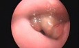 Épiglottite à laryngoscopie en ambulatoire