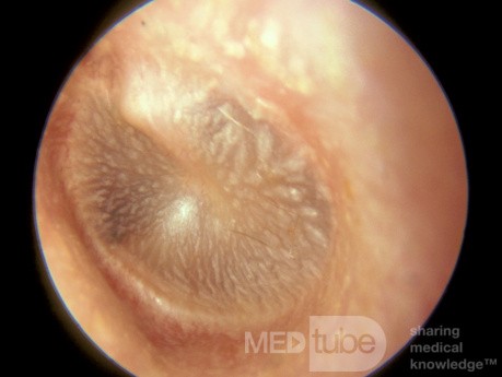 Patchs à la kératine du membrane tympanique