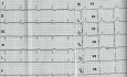 Cardiomyopathie hypertrophique - l'ECG, l'échocardiographie et le traitement