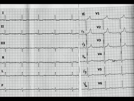 Cardiomyopathie hypertrophique - l'ECG, l'échocardiographie et le traitement