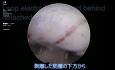 Fibrome Cervical Volumineux