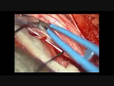 Tumeur de la Moelle Epinière - Neurofibrome Intra-Dural - Excision Microchirurgicale