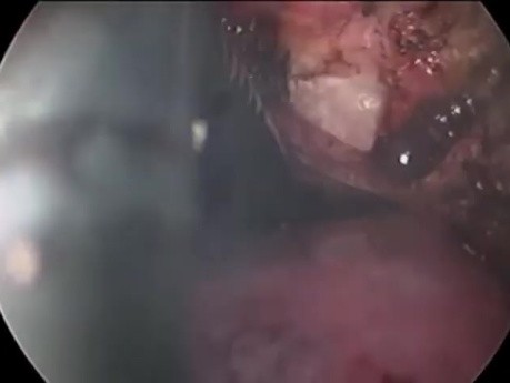 L'hystérectomie laparoscopique par incision unique.