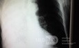 La radiographie du thorax sur la projection postéro-antérieure - PA