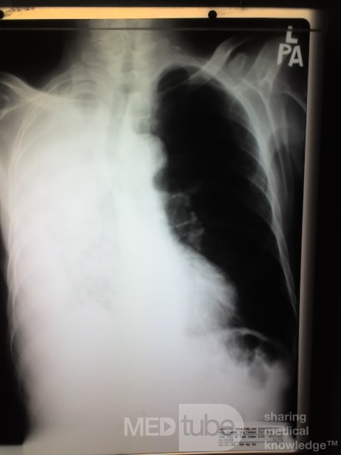 La radiographie du thorax sur la projection postéro-antérieure - PA