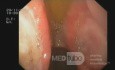 Les deux ulcères du bulbe duodénal - "kissing ulcers".